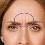 Brow Lift and Glabellar Lines Facial Sofwave Treatment