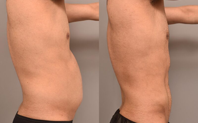 Liposuction In Weight Loss